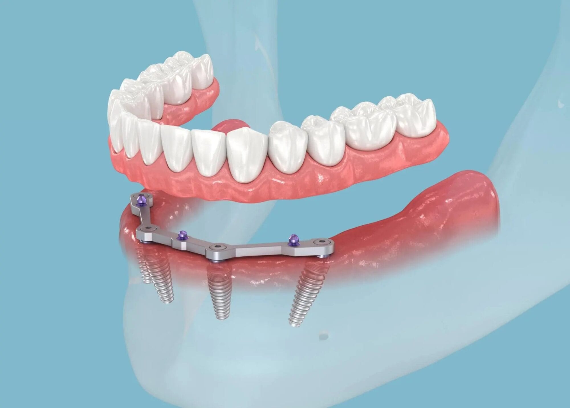 All-on-4 implant tedavisi ile alt çeneye sabit protez uygulaması