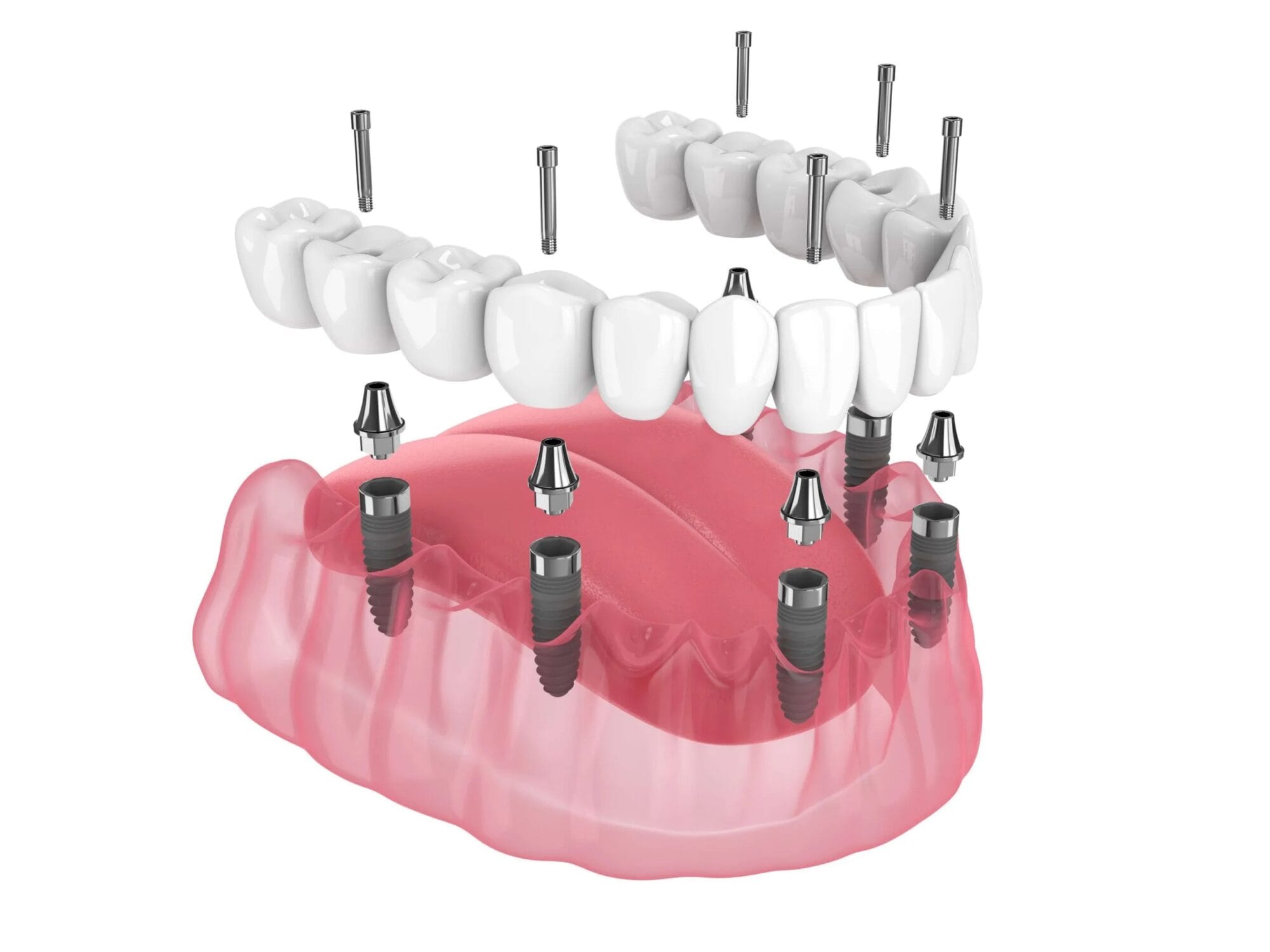 All-on-6 implant uygulaması ile sabit diş protezi yerleştirilmiş alt çene modeli