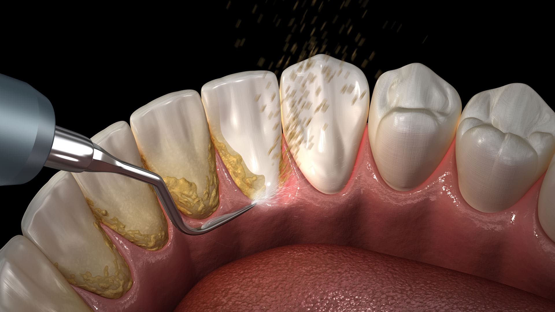 Ultrasonik cihazla diş taşı temizliği yapılan dişlerin 3D gösterimi