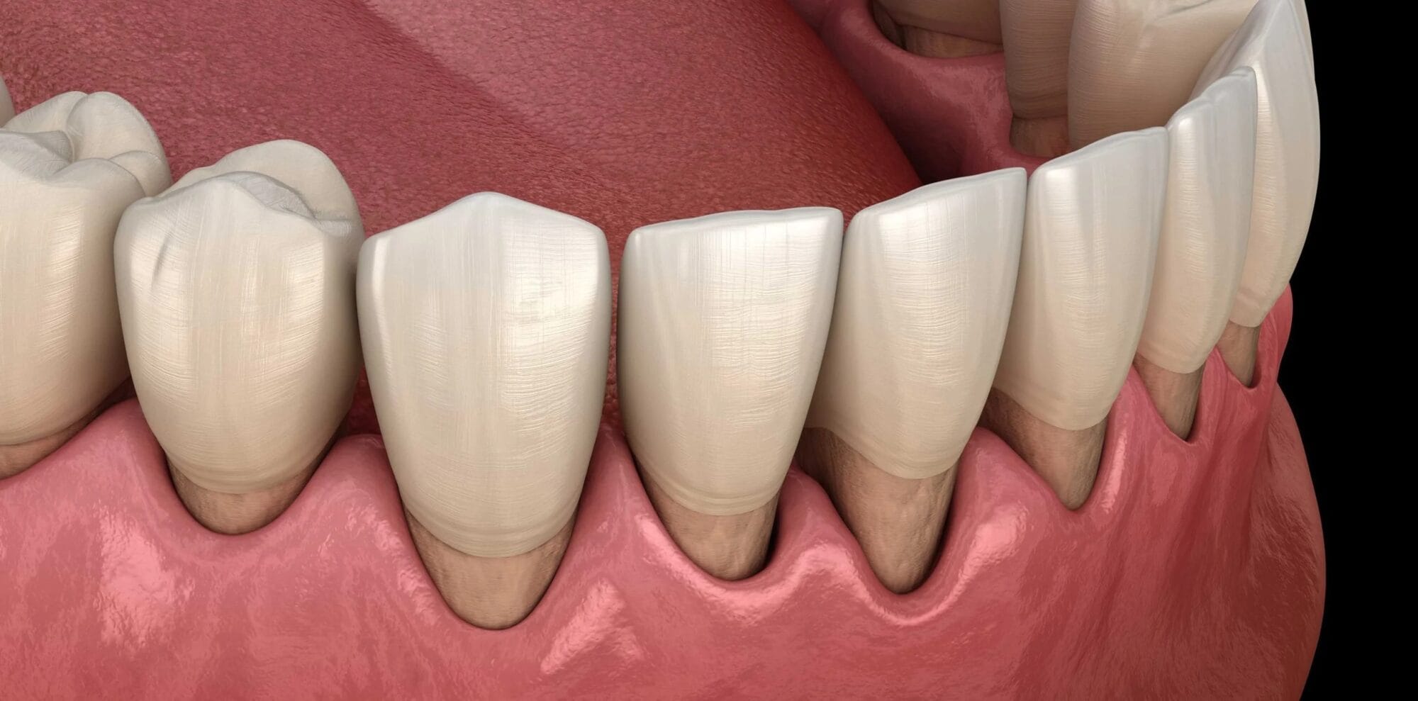 Diş eti çekilmesiyle açığa çıkmış diş köklerini gösteren 3D model
