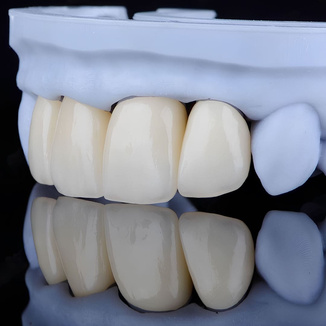 Geçici sabit diş protezlerinin ön bölgedeki estetik görünümünü gösteren dental model