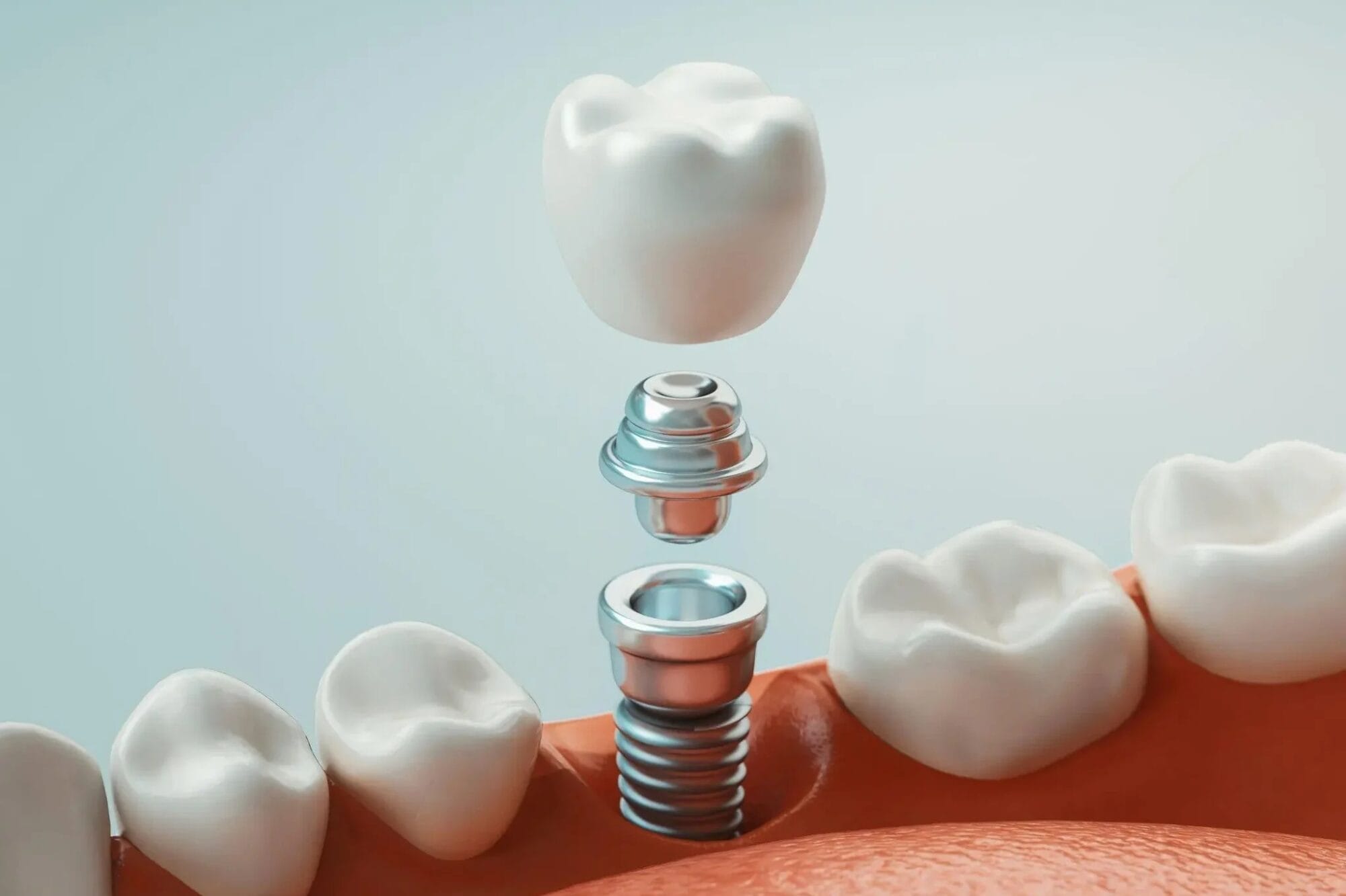 Diş implantı uygulaması – Antalya’da modern implantoloji çözümü
