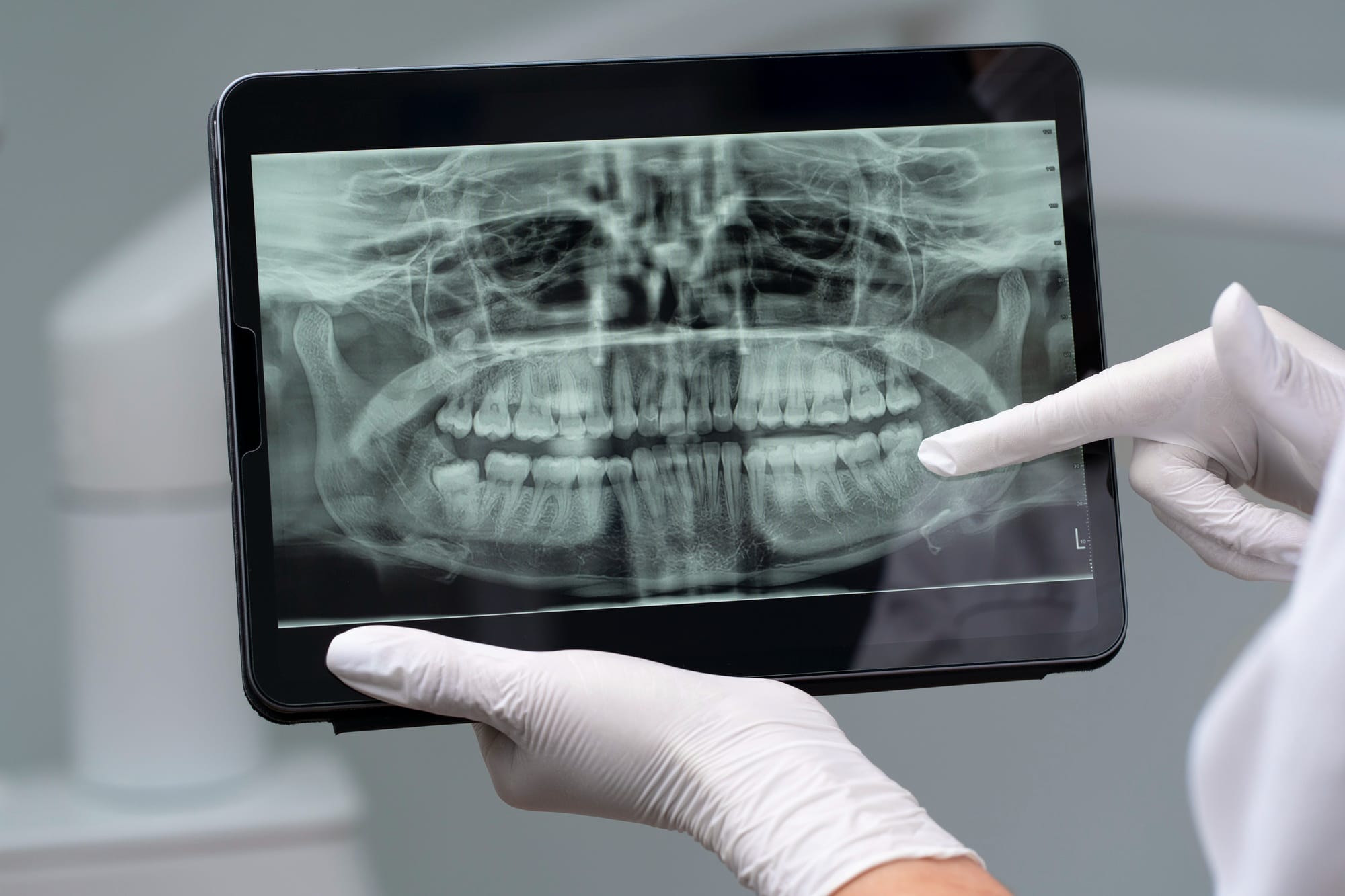 Tablet ekranda panoramik diş röntgeni incelemesi, ilk muayene sırasında yapılan teşhis işlemi