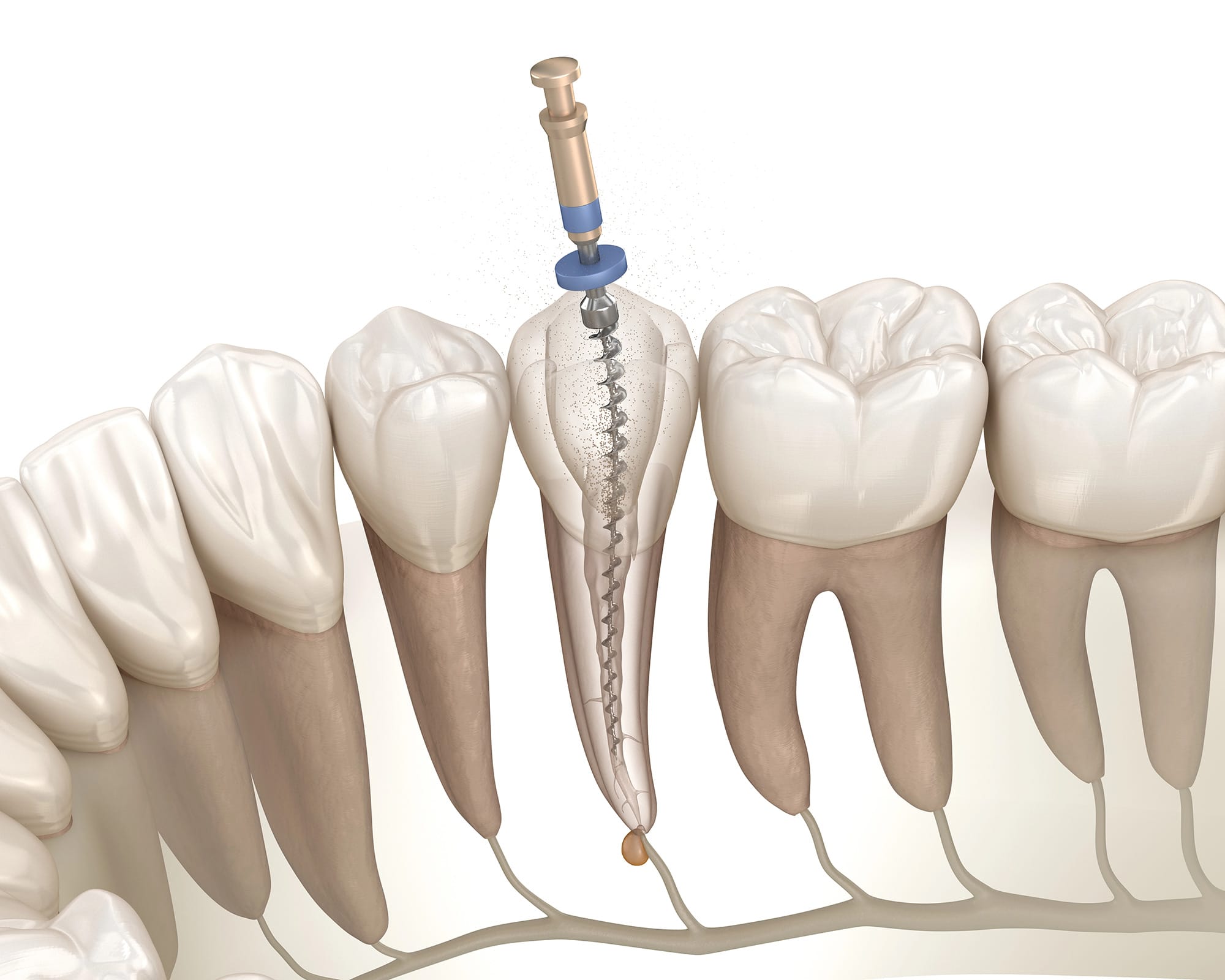 Rejeneratif endodontide kanal içi temizliği gösteren detaylı 3D animasyon