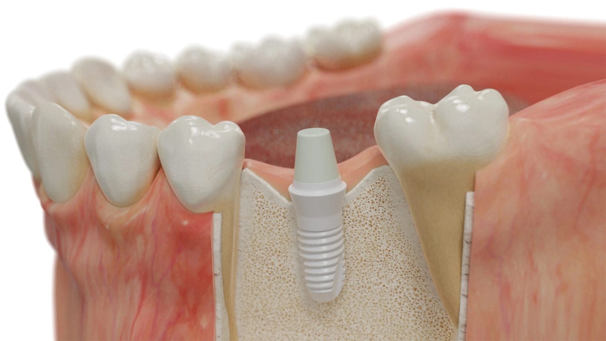 Seramik implantın çene kemiğine yerleştirilmiş halini gösteren 3D kesit görseli