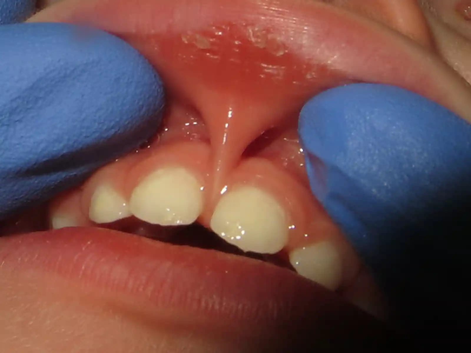 Üst dudak bağının (labial frenulum) konumunu gösteren muayene görüntüsü