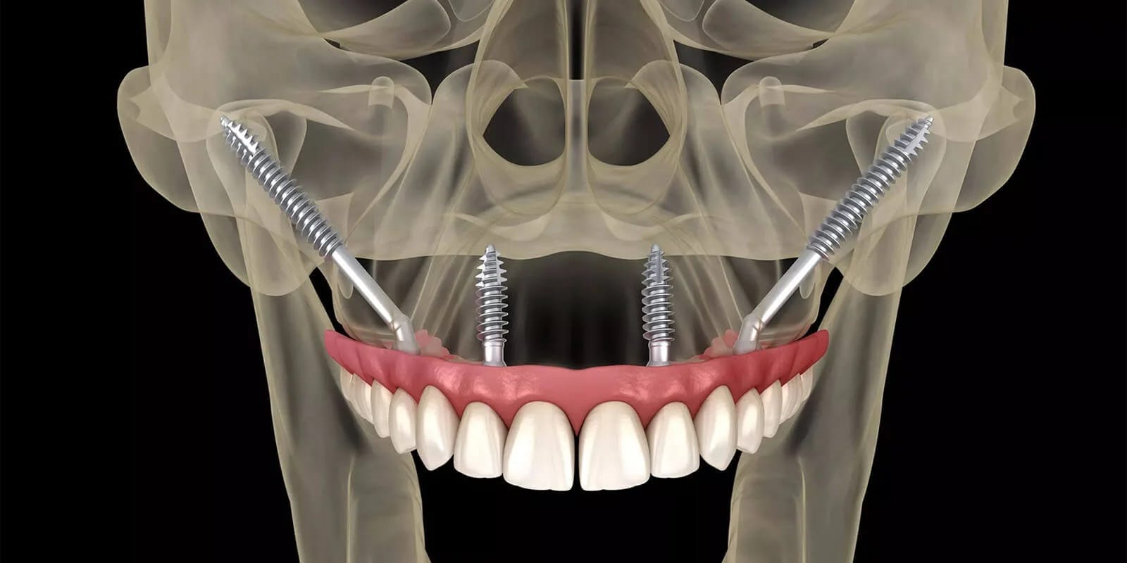 Zigoma implant yerleşimi ve sabit üst çene protezi uygulamasını gösteren 3D görsel