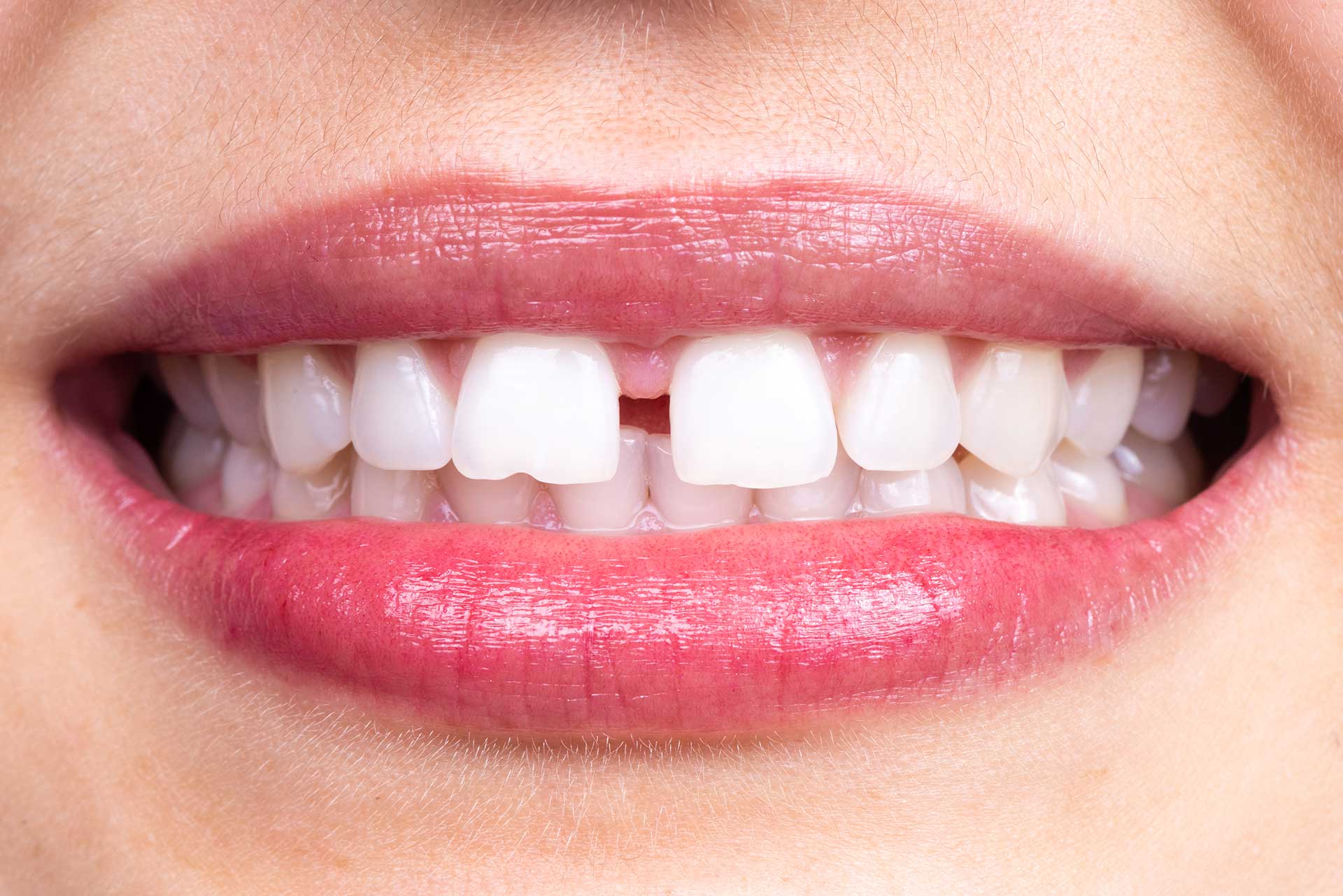 Ön dişler arasında boşluk (diastema) tedavi öncesi yakın çekim görüntü