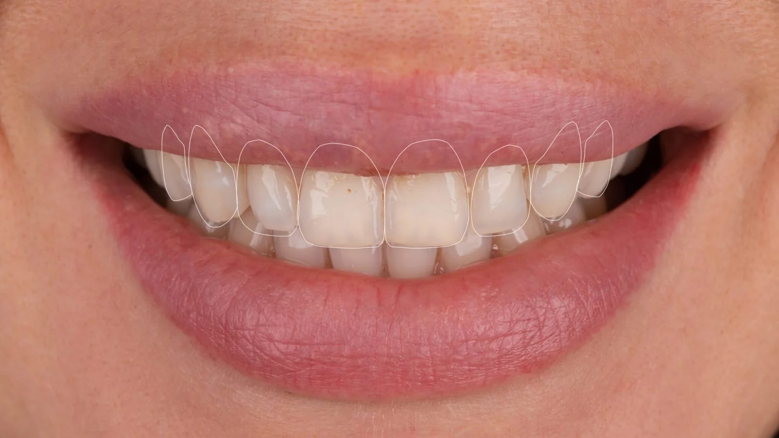 Digital Smile Design uygulamasıyla Antalya’da estetik gülüş tasarımı